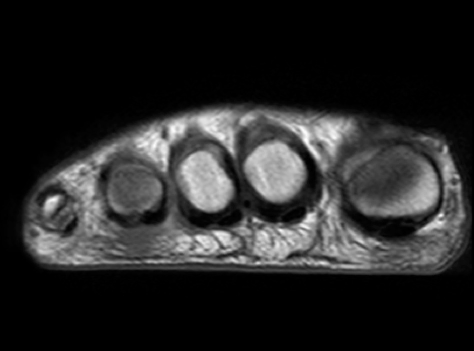 Figure 4 for case Advential bursitis